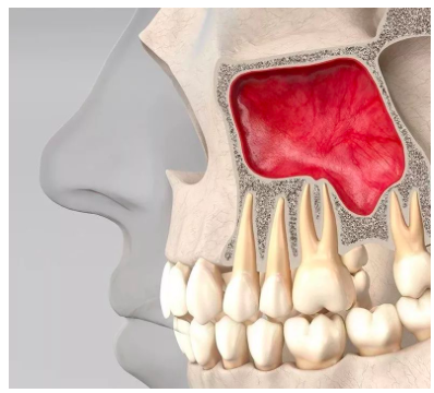 上颌窦:后牙牙根上方的"天花板",为啥在种植牙手术中很重要?