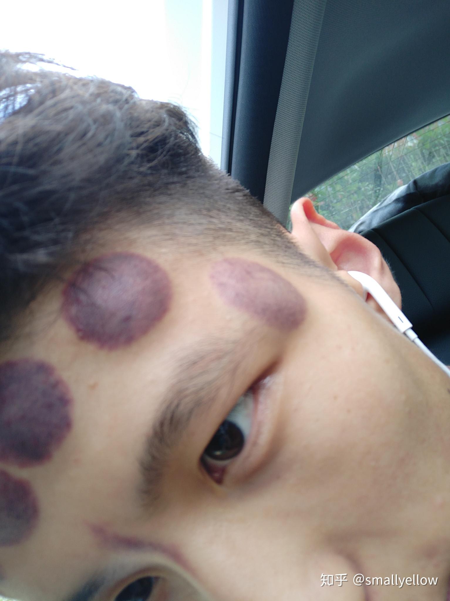 太阳穴拔罐会怎样