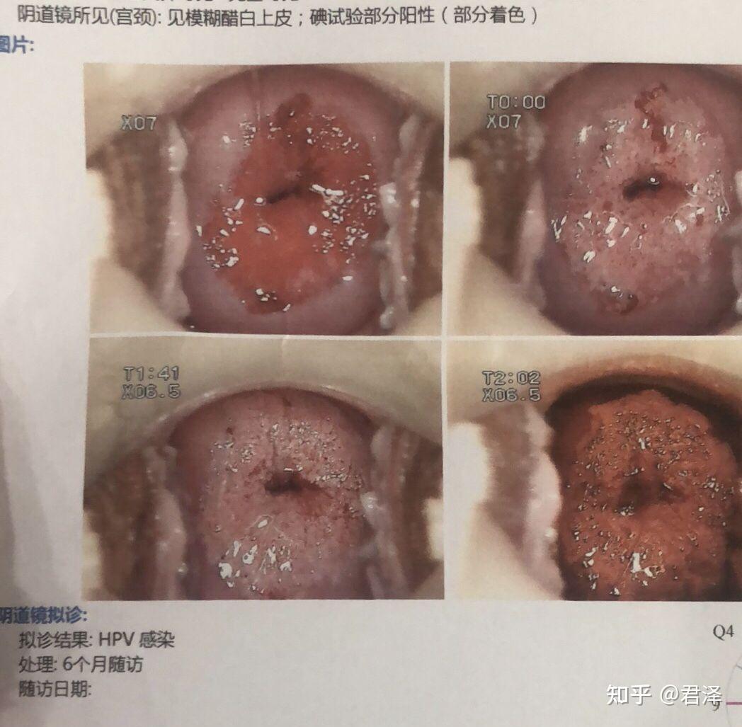 妇科hpⅴ有什么症状图片