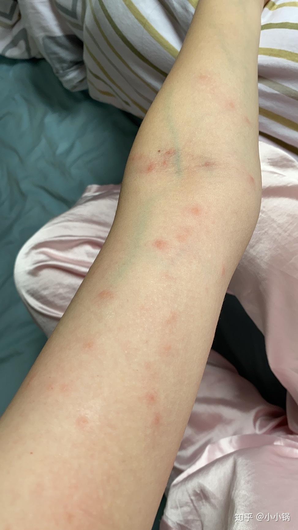 养猫之后身上起小红点是什么?怎么办? - 知乎