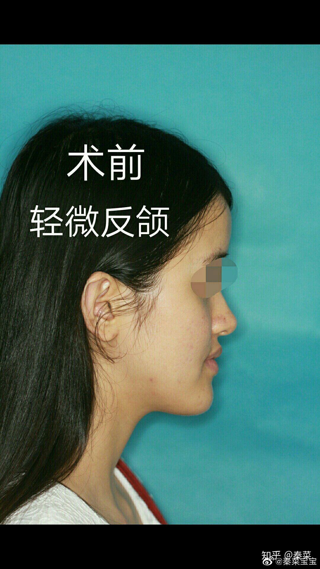 正颌手术失败的你现在怎样了