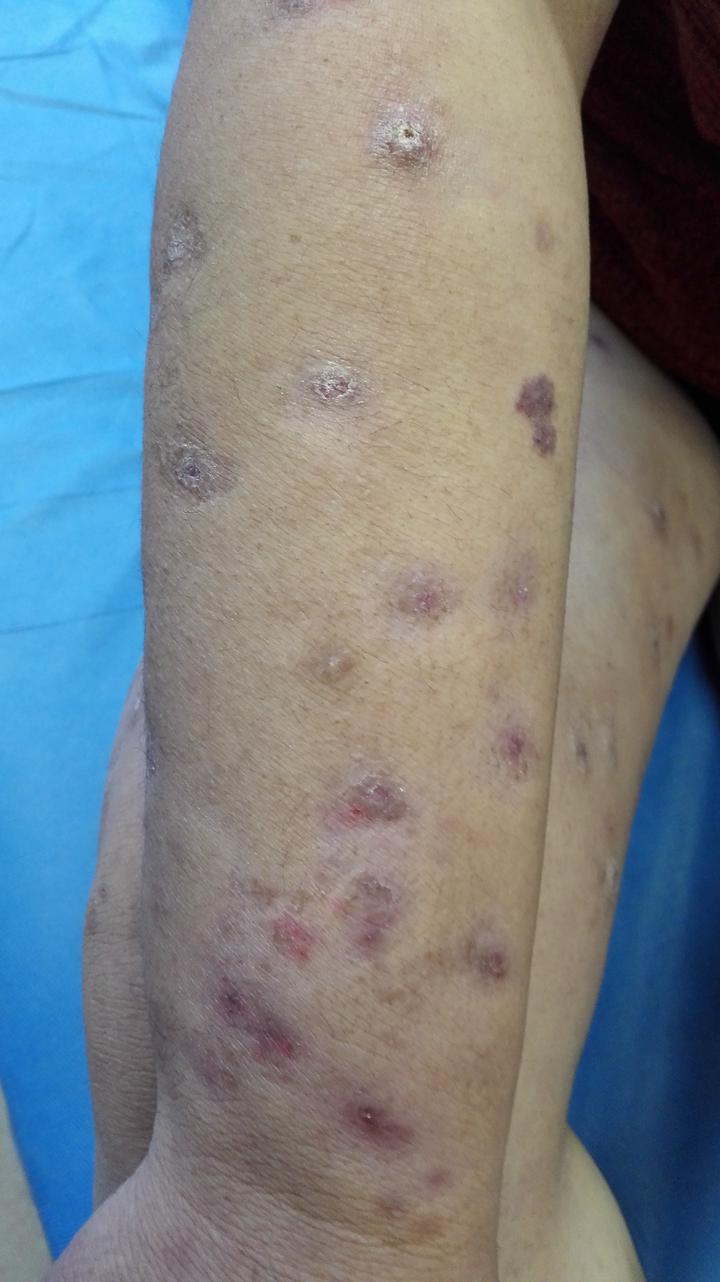 结节性痒疹中西医治疗方式