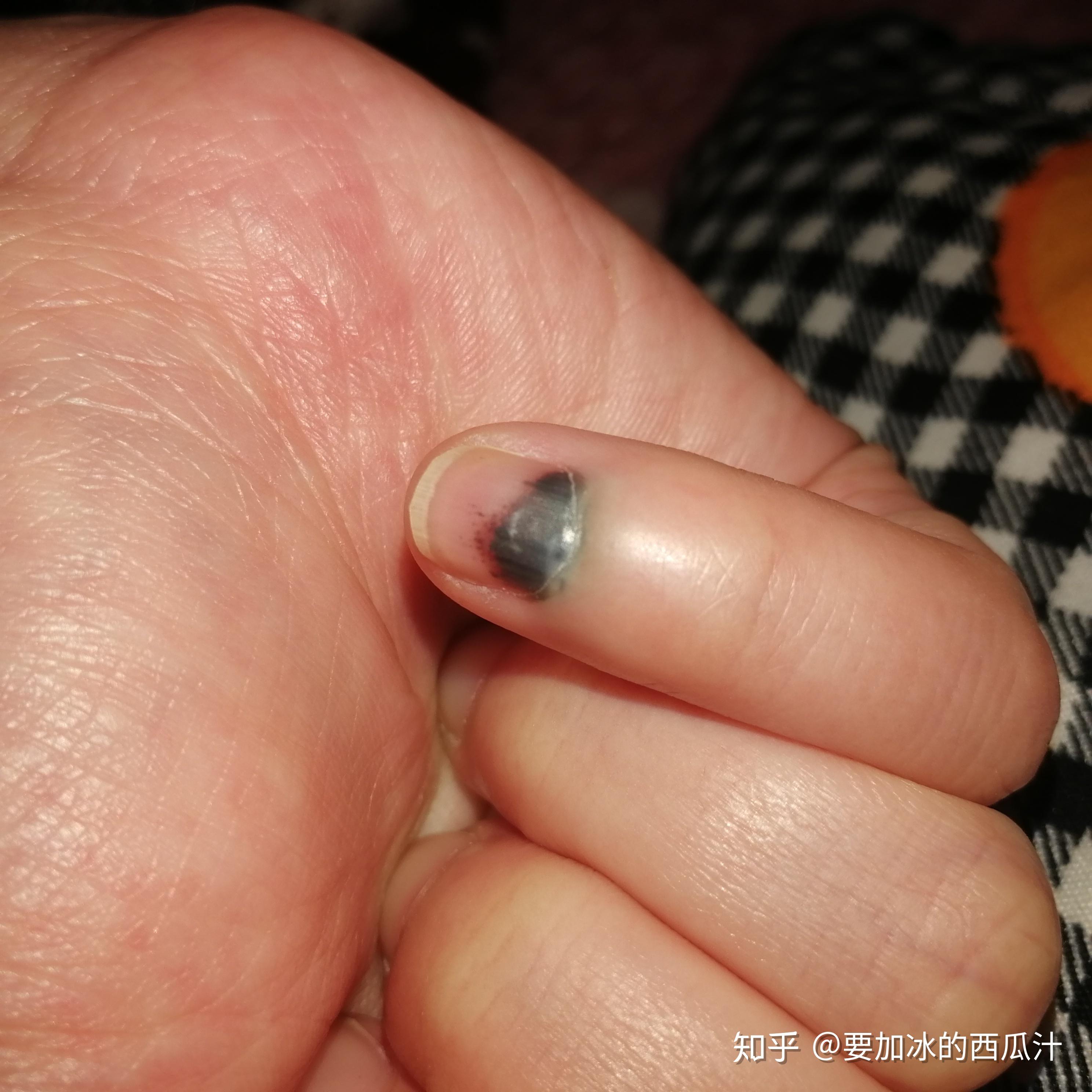 手指被门夹肿还夹出淤血是什么感受? - 知乎