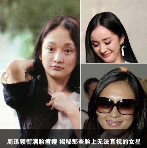 原来杨幂章子怡也有青春痘揭秘那些容易痘的女星是如何护肤的