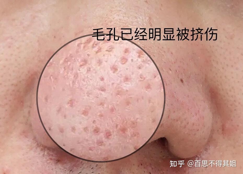 鼻子毛孔粗大,全是油脂粒怎么办? - 知乎