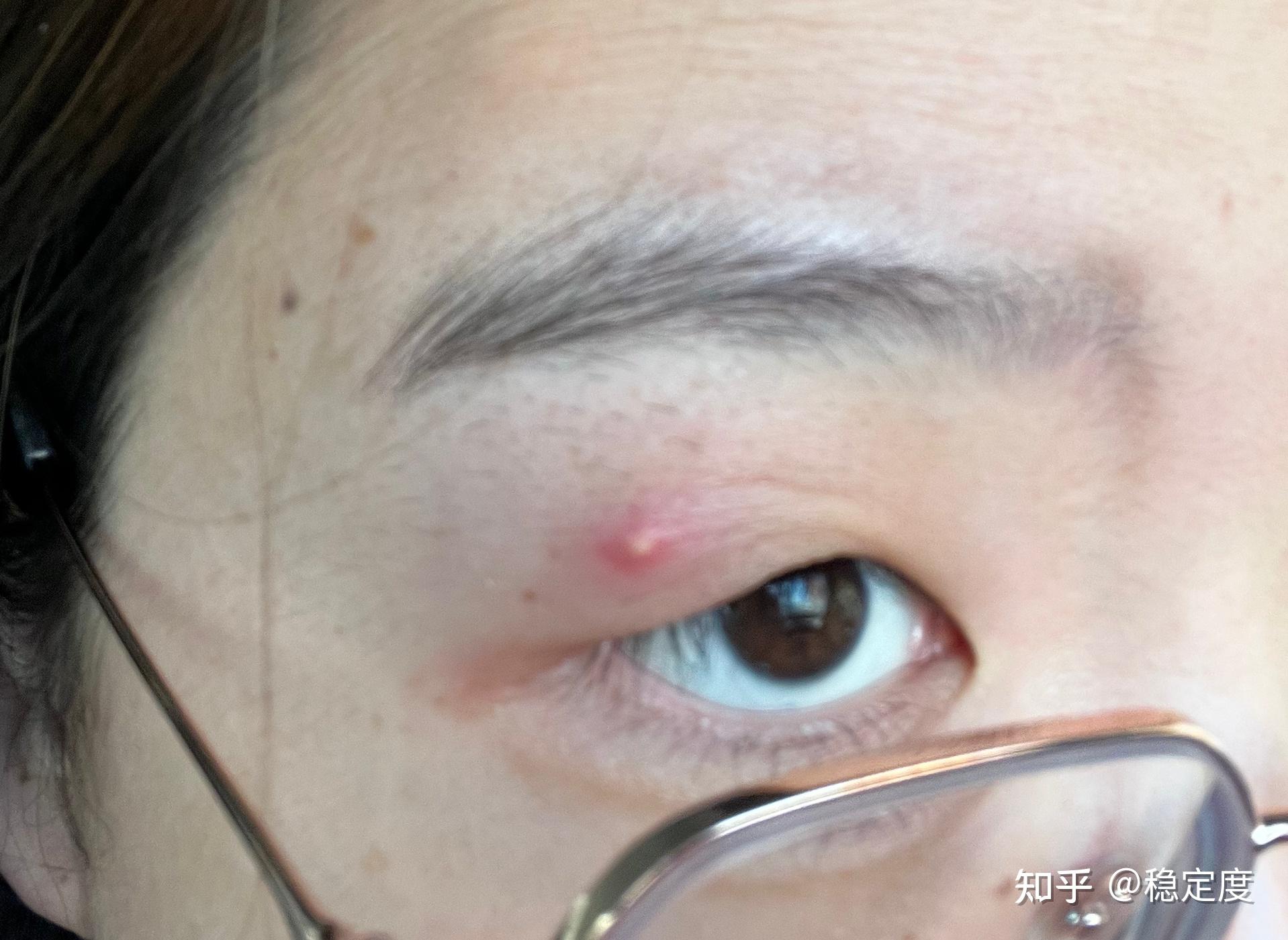 眼皮上起了一个粉刺是什么感受? - 知乎
