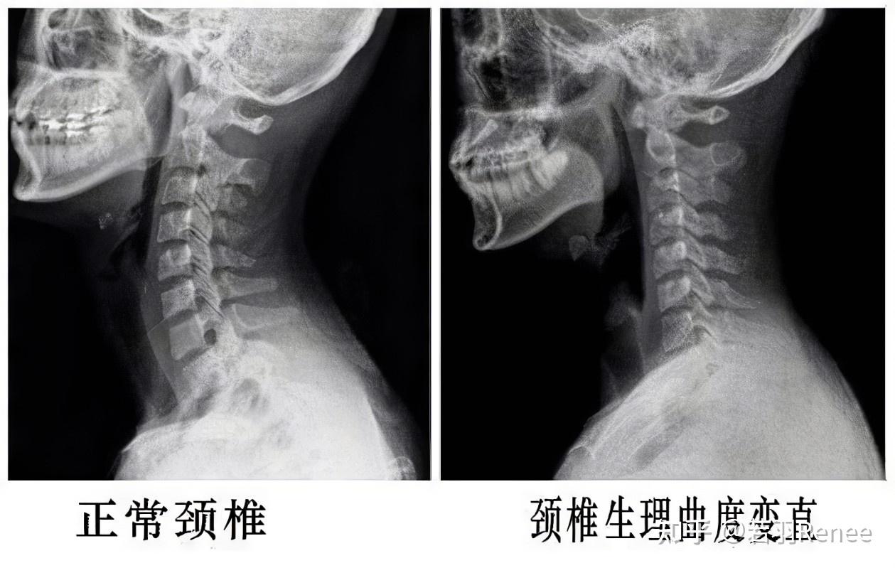 颈项强直图片图片