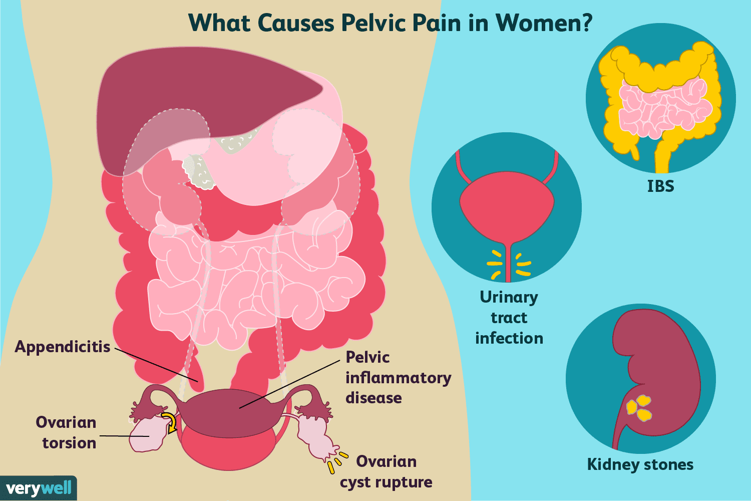 关于女性慢性下腹痛，想知道有哪些常见原因吗？医生直接告诉你