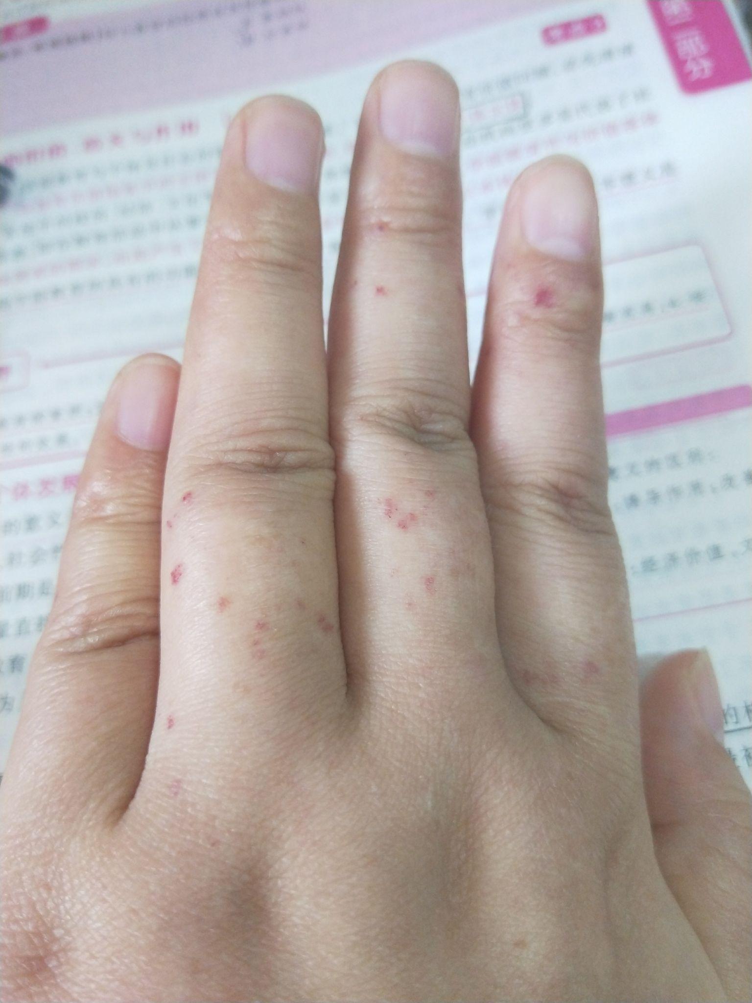 手上因为冻疮长的这些红疙瘩到底是什么东西好多年都没有消掉