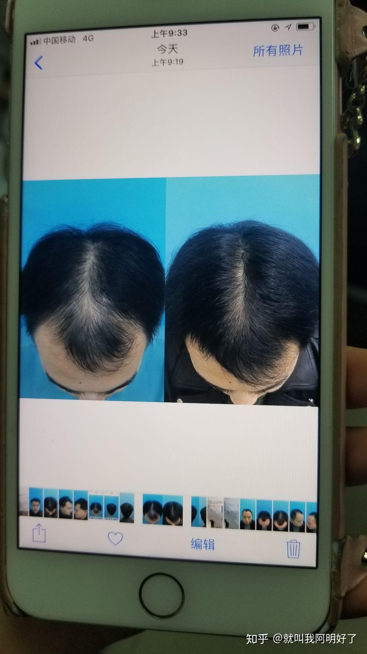 在某宝上买的海维斯育发液有用吗