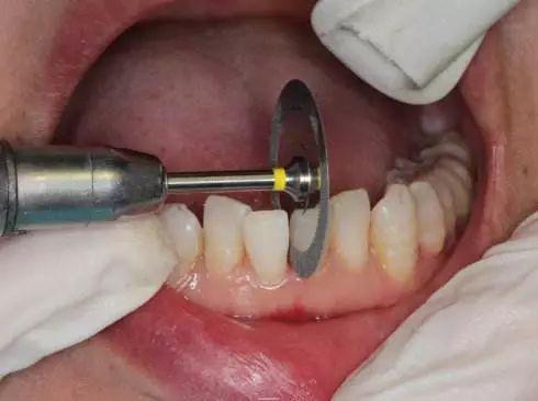 什么是牙齿片切