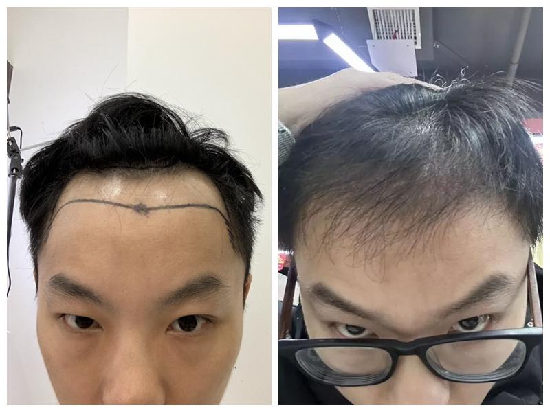 植发为什么那么贵？植发医院医生该怎么选？做植发是一种什么样的体验？ - 知乎