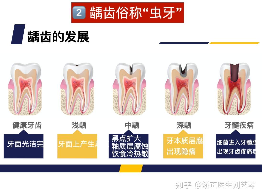 因智齿致邻牙龋坏穿髓的根管治疗和高嵌体修复 - 牙科实战 - 看牙有道|佛山南海王琪牙科博客