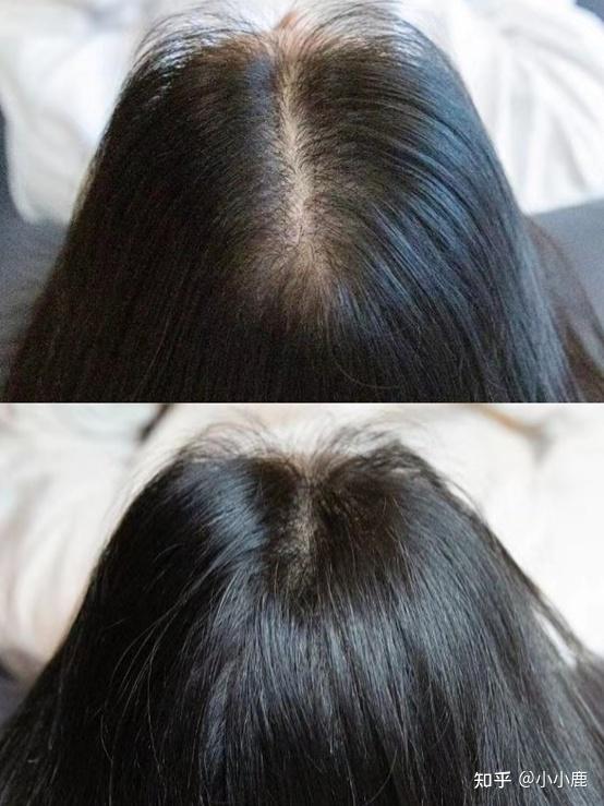 头顶上头发稀疏怎么办