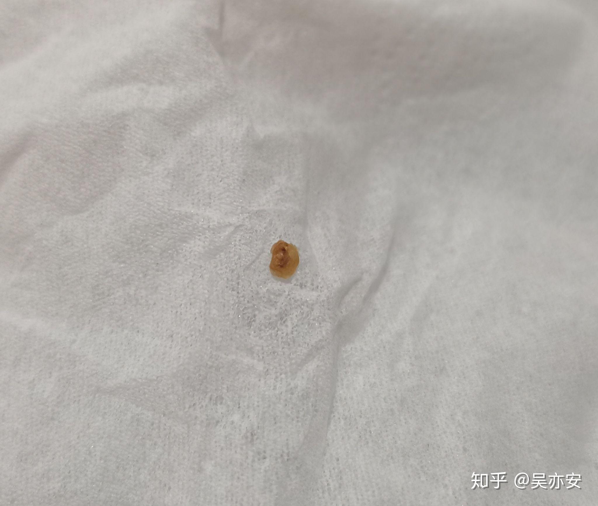 请问你们耳朵壁会长黑头吗一颗一颗的黑的