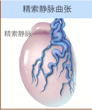 怎么判断自己是否得了精索静脉曲张?