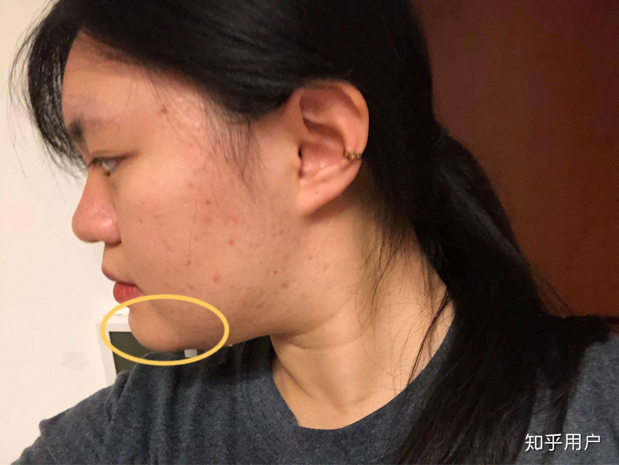 下巴太翘了怎么办