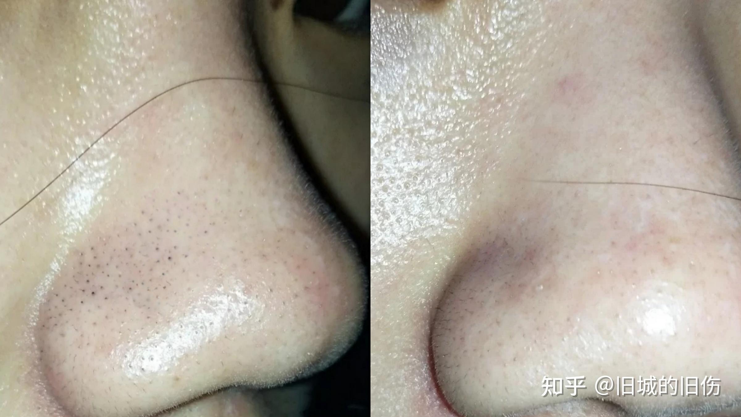 黑头大到直接挤出来是什么感受?