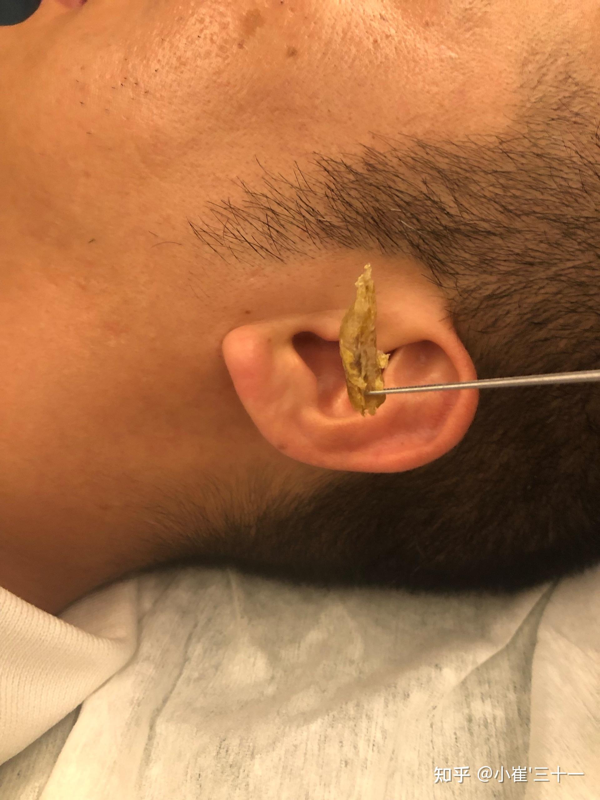 你们掏出来的耳屎有多大? - 知乎