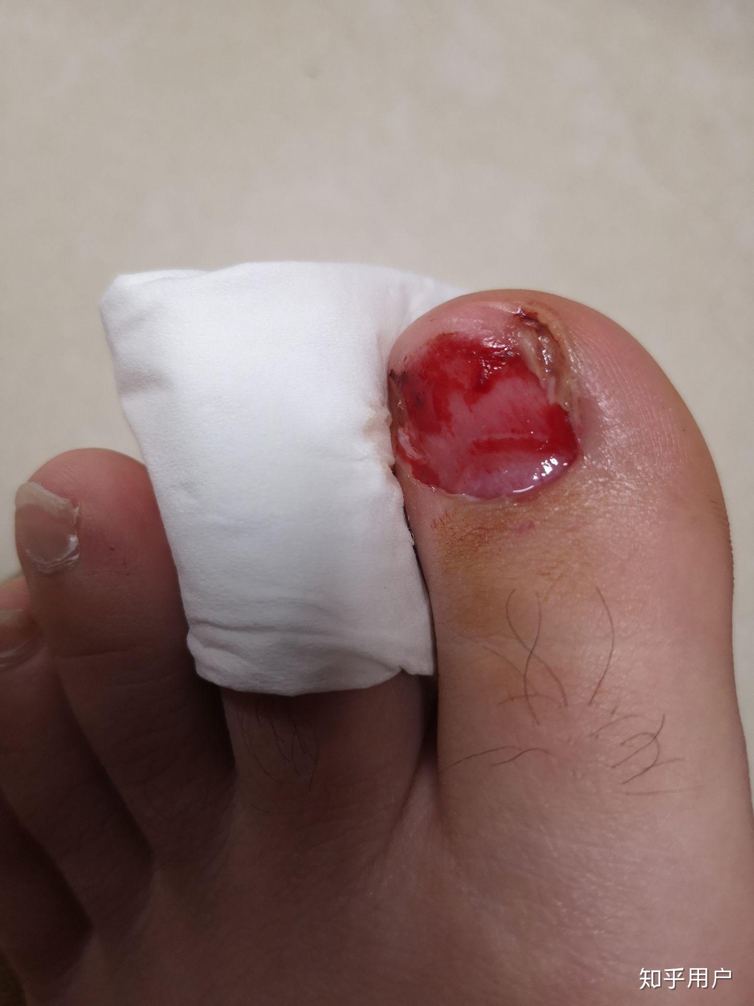 拔指甲是什么样的体验?很疼么? - 知乎