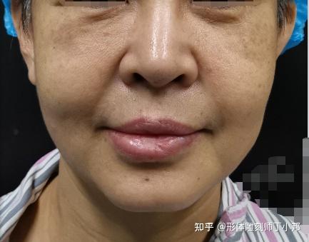 苹果肌下垂凹陷怎么办?