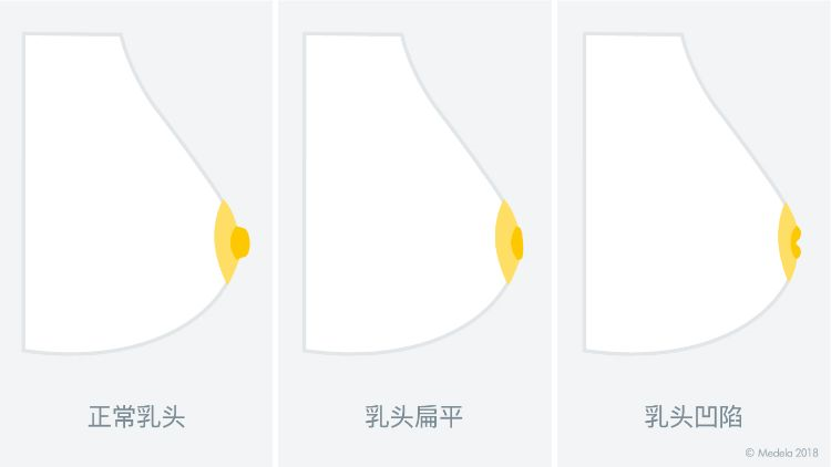 現在懷孕5個月了,可我乳頭內陷,要怎麼給寶寶餵奶?