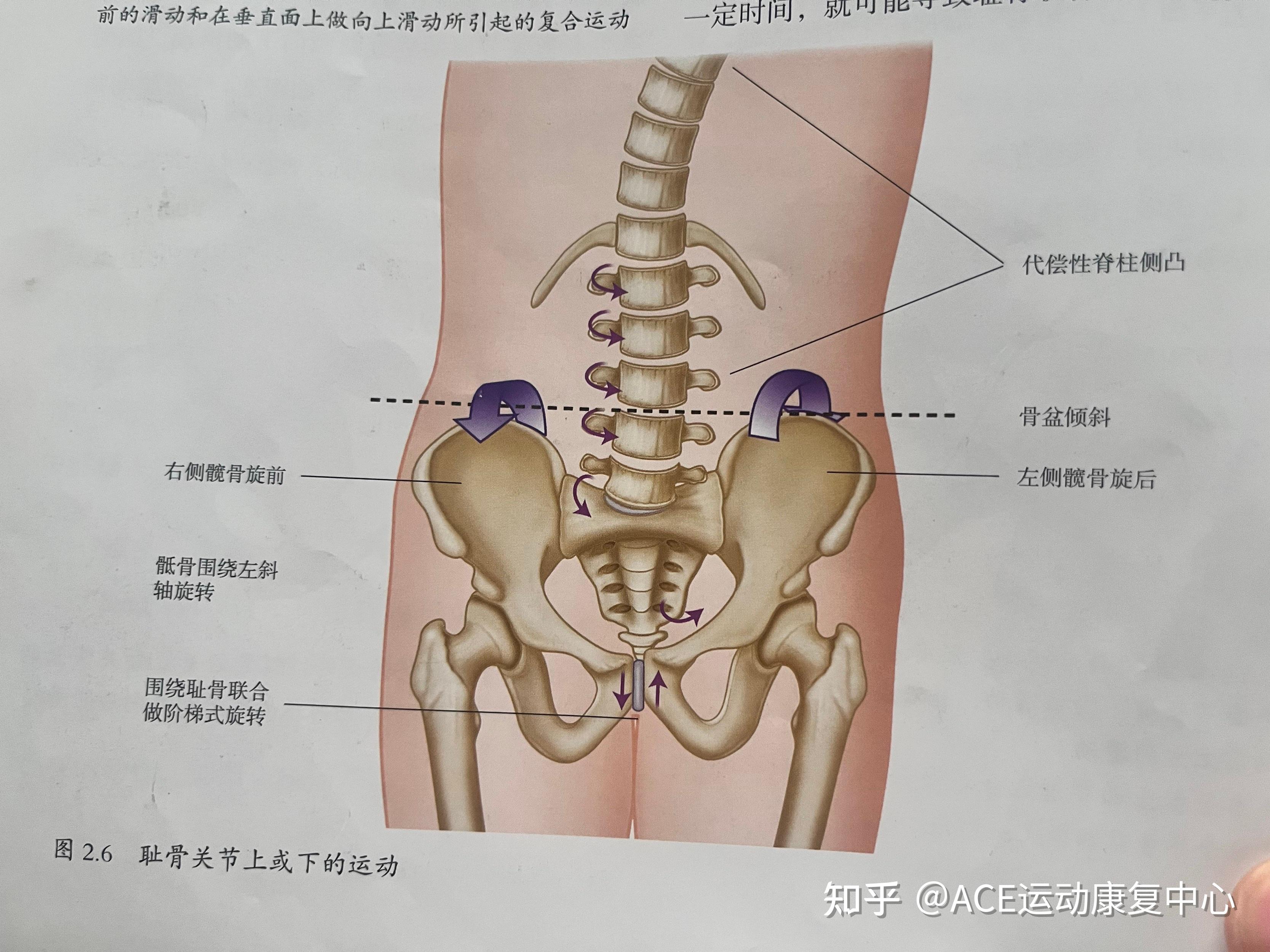 🌟【骶髂关节炎久治不愈?你需要理解身体的「多米诺效应」】