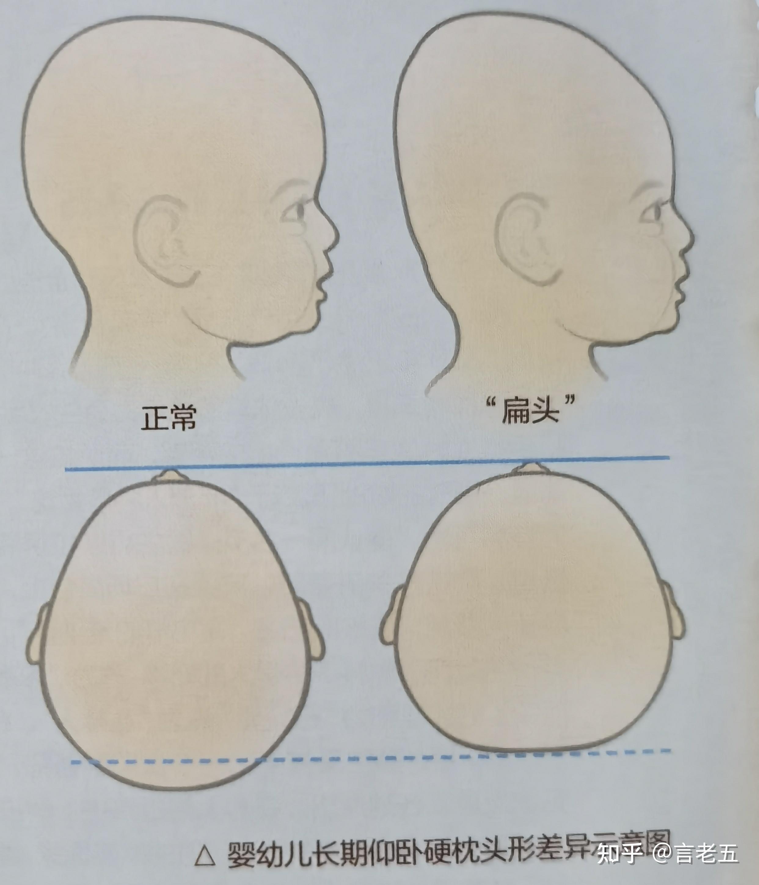 超级大的后脑勺