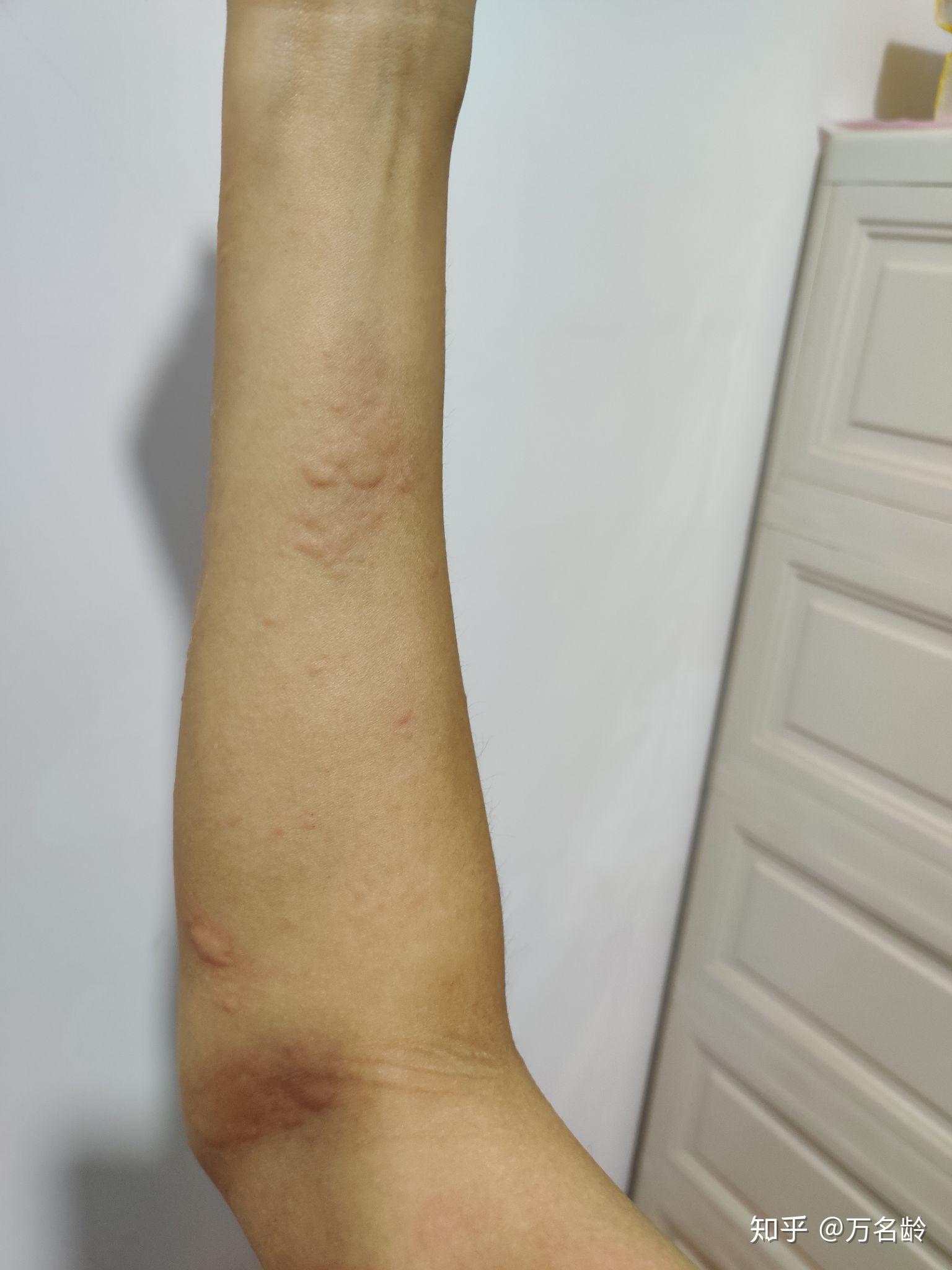 对狗过敏的症状有哪些? - 知乎