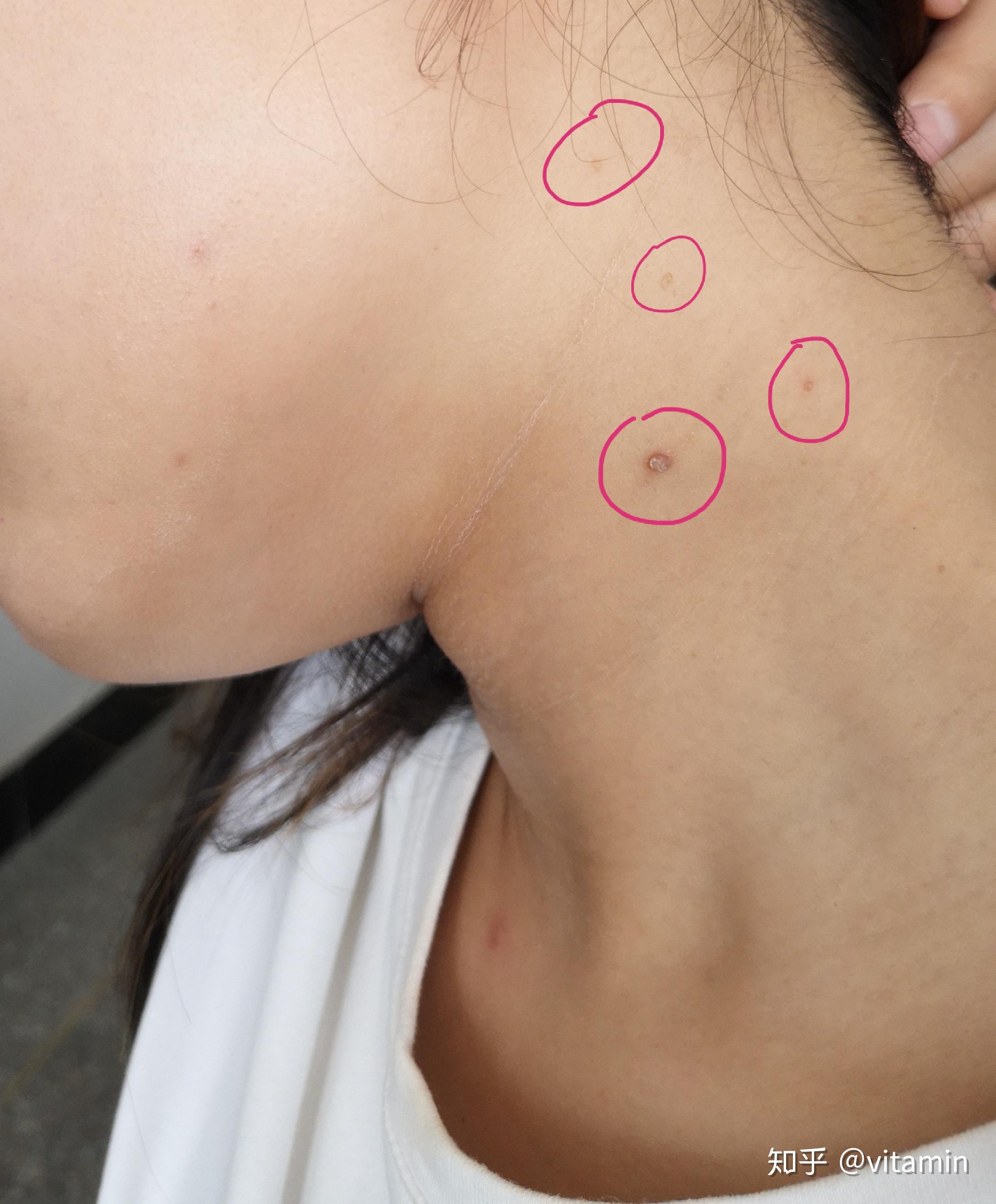请问脖子上的小肉粒这是什么? - 知乎