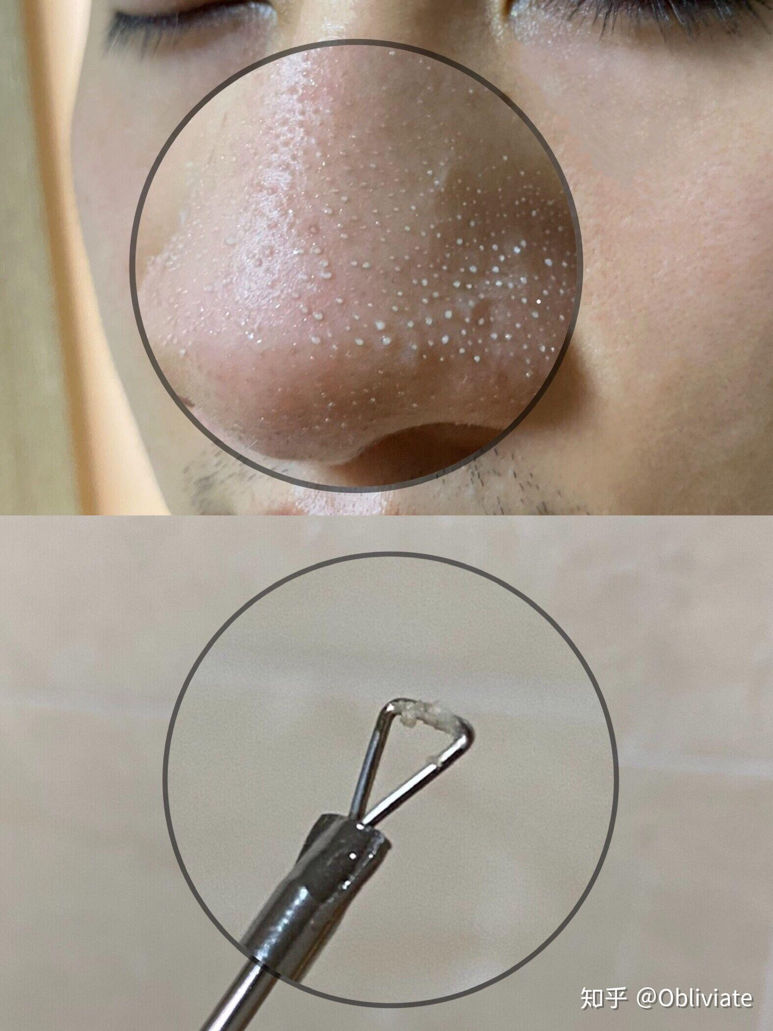 总是挤黑头怎么办