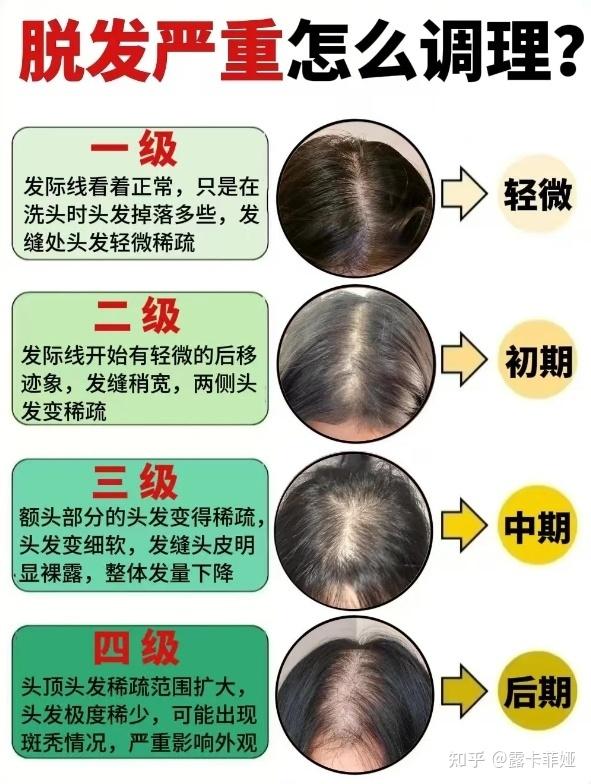 22岁发际线后移呈m形,除了植发有没有其他的方法 ?