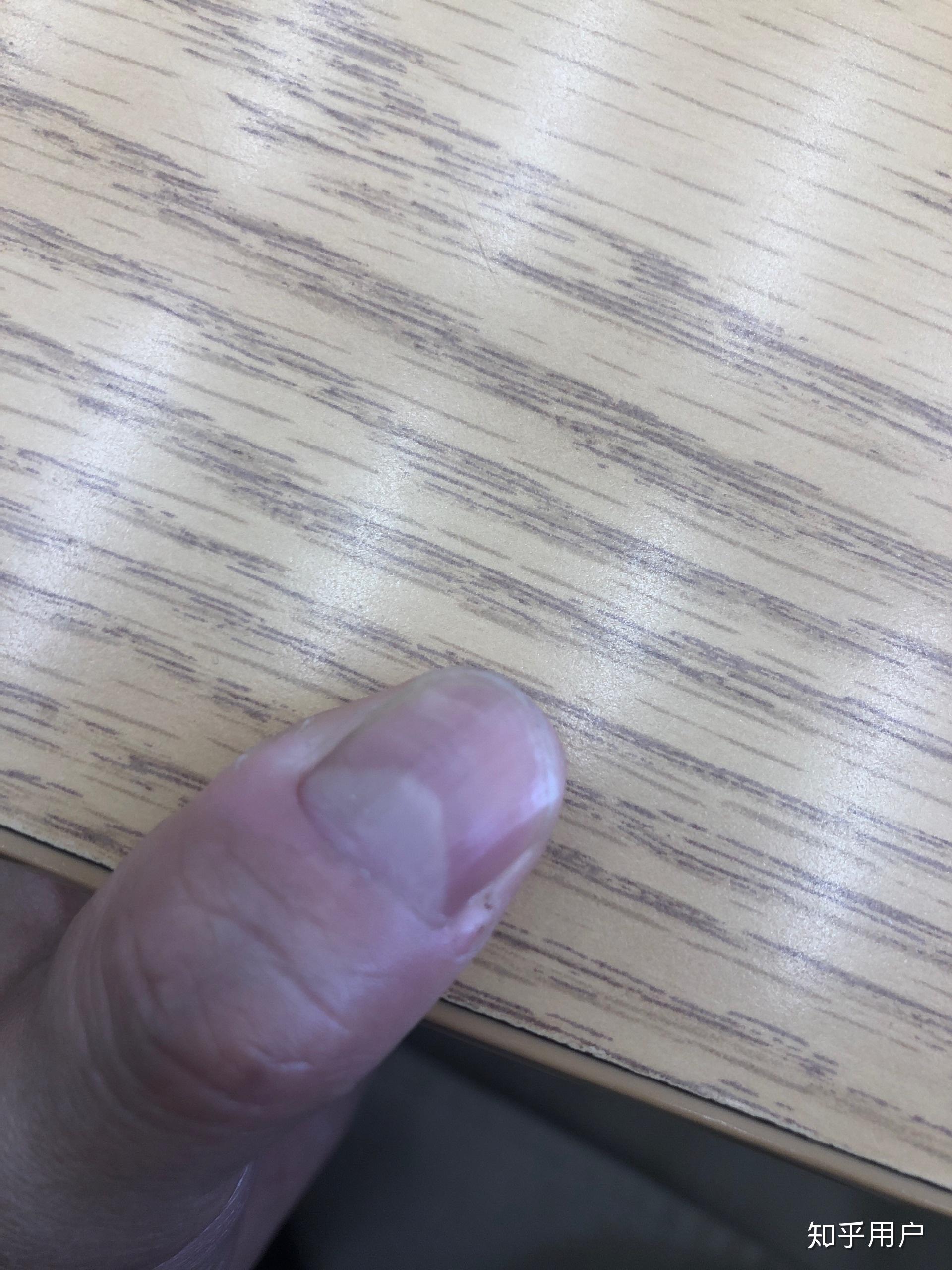 大拇指指甲凹凸不平,有凸起的横纹和凹陷,很多年了也没有其它问题,去