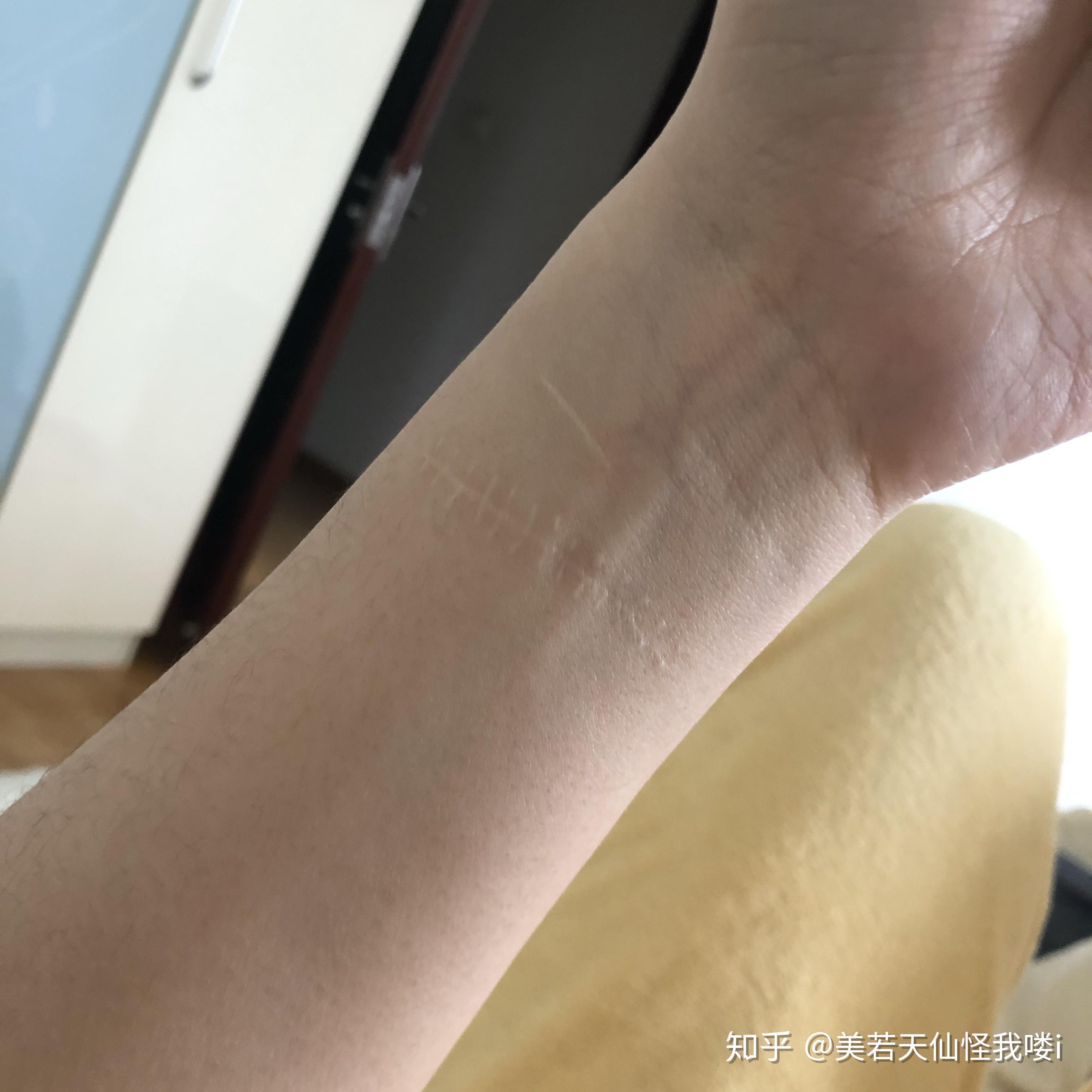 割腕的疤可以去掉吗? - 知乎