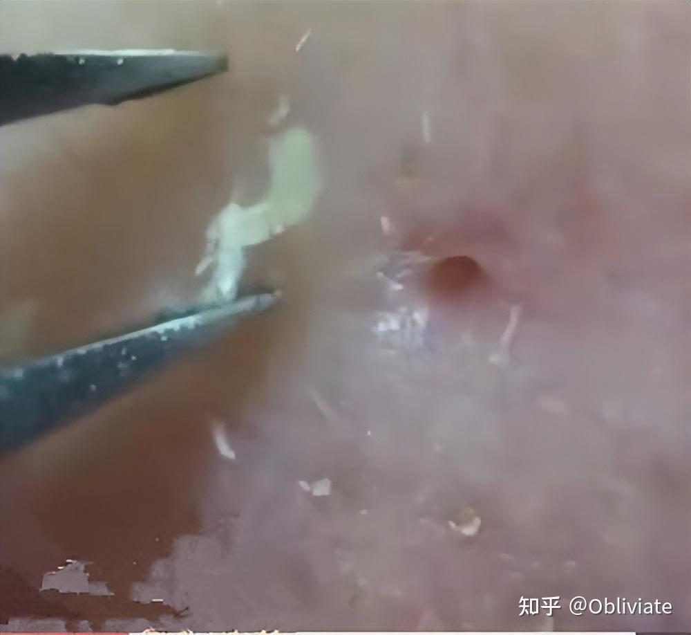 鼻子皮肤会不会长寄生虫?