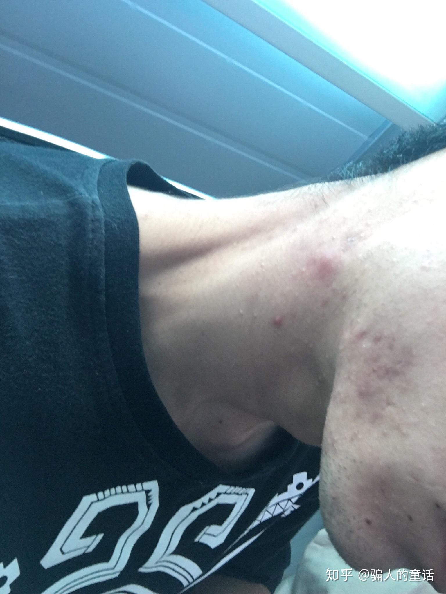 下巴和脖子交界处总长痘痘是什么原因该怎么办