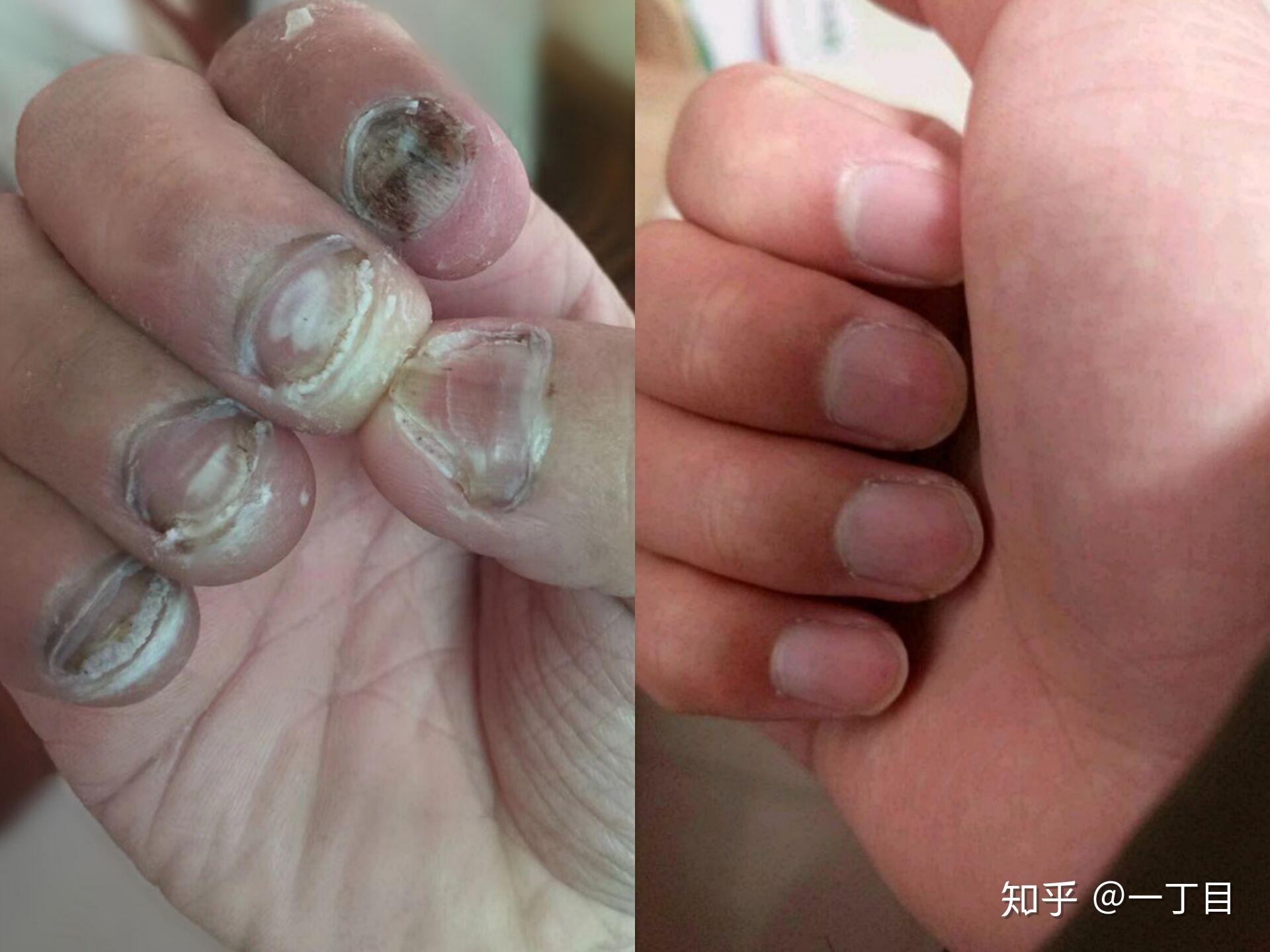 脚指甲长灰指甲去医院能看好还是相信私人的中药护理店