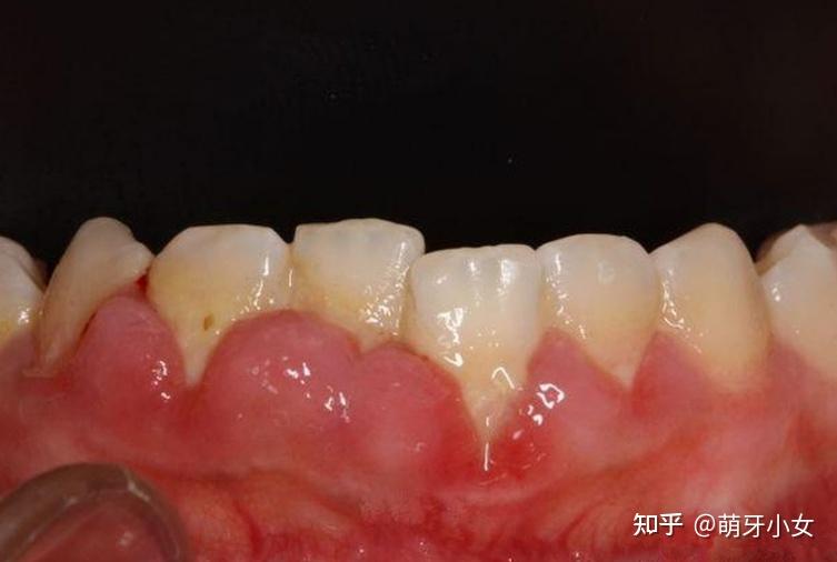 为什么会得青春期牙龈炎有什么表现