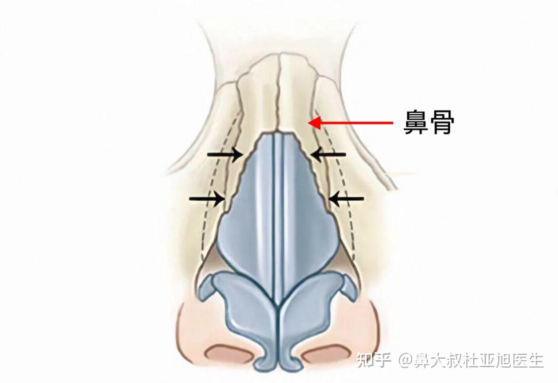 鼻骨内推会拉进眼距吗?