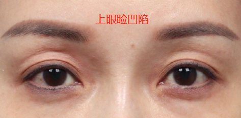 上睑凹陷可以做双眼皮吗眼窝凹陷怎么办哪种填充方式好