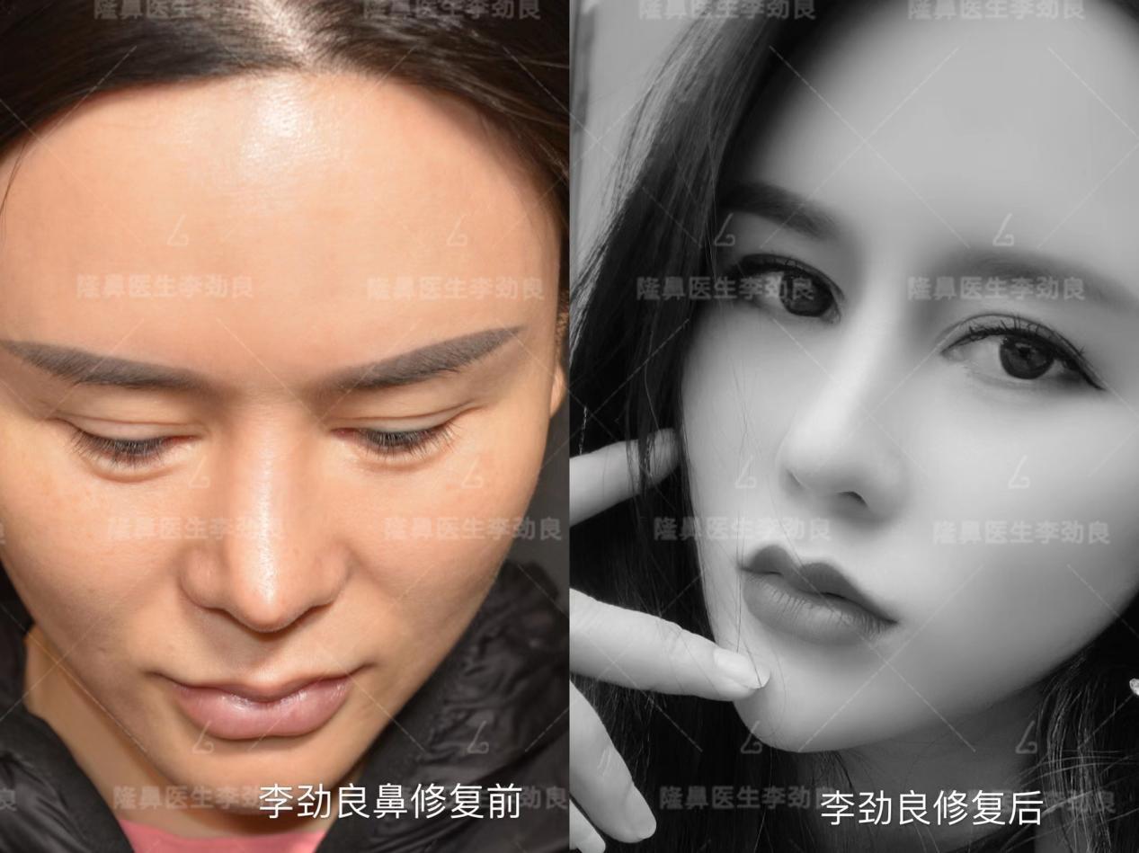 l型假体隆鼻真的很可怕吗