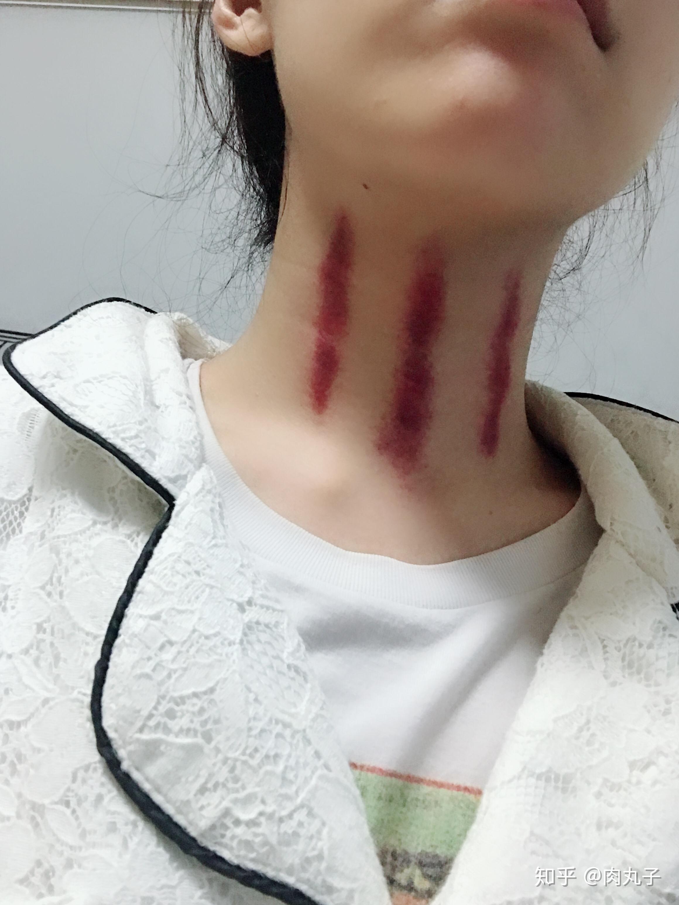 为此问题开了知乎账号咳嗽时候把嗓子揪出淤血到底有没