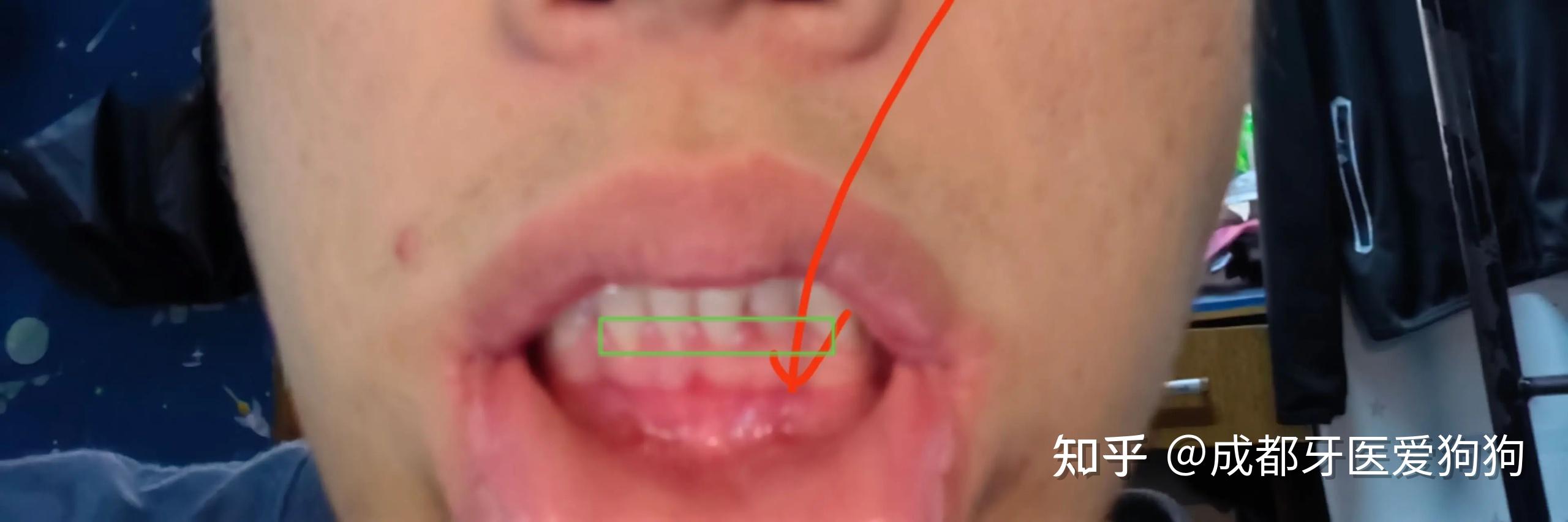 这是艾滋病口腔症状的龈缘红线吗? - 知乎