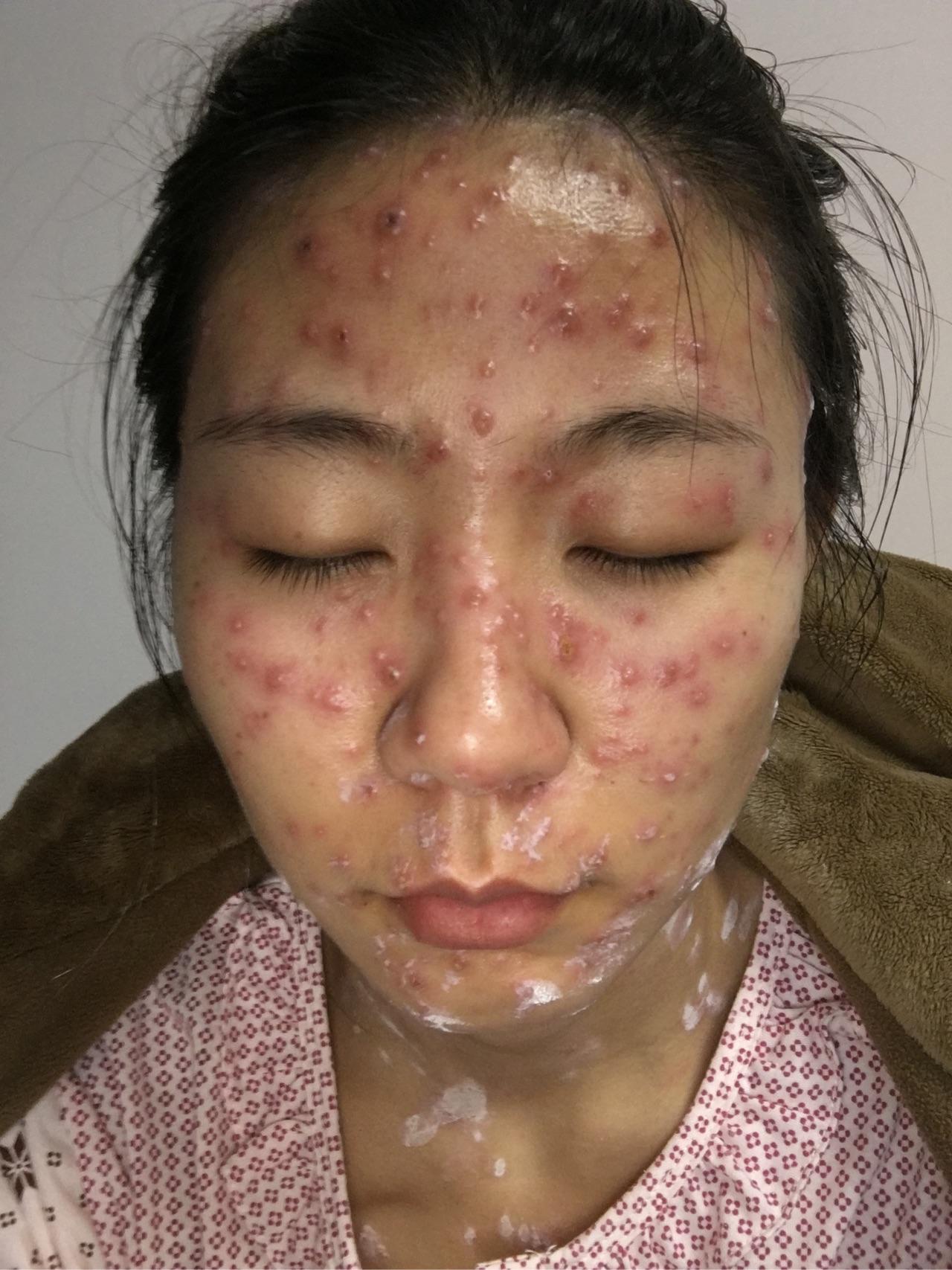 成人长水痘是什么样的经历