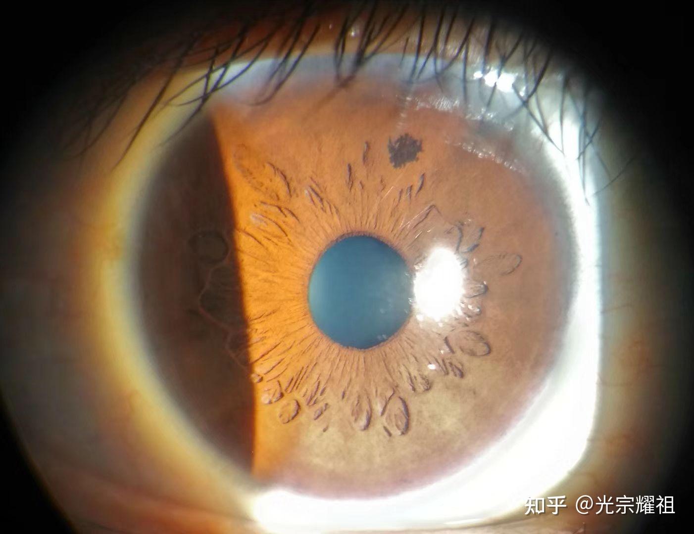 瞳孔里长痣是怎么回事? - 知乎