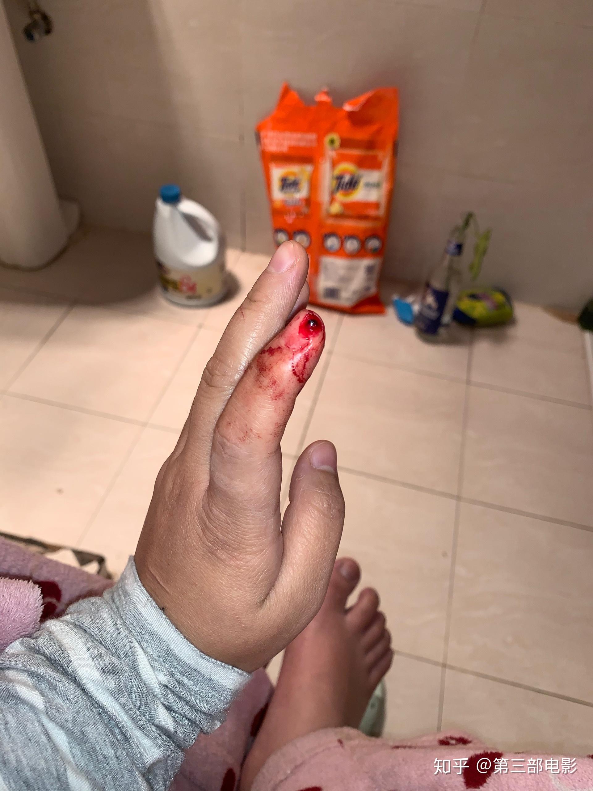 手指被割掉一块肉是什么体验? - 知乎