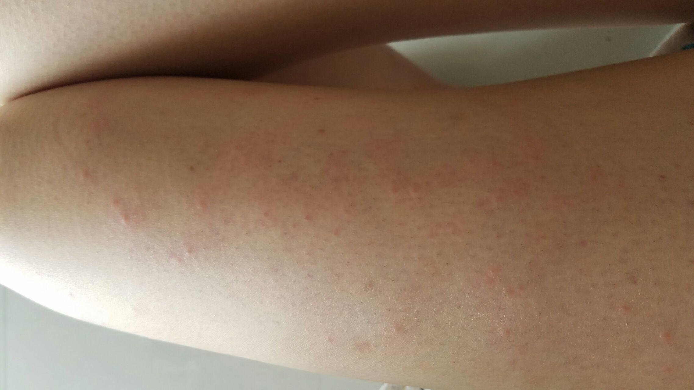 用过激光脱毛仪以后过敏一样有好多痒疙瘩怎么办? - 知乎