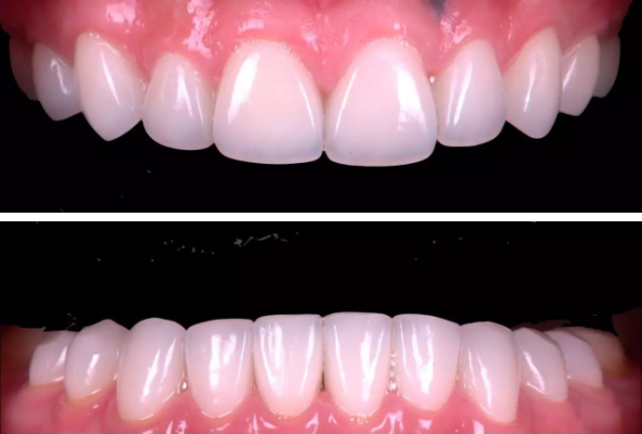 西安牙齿矫正:『以dsd美学设计为导向』牙列重度磨耗患者全口咬合重建