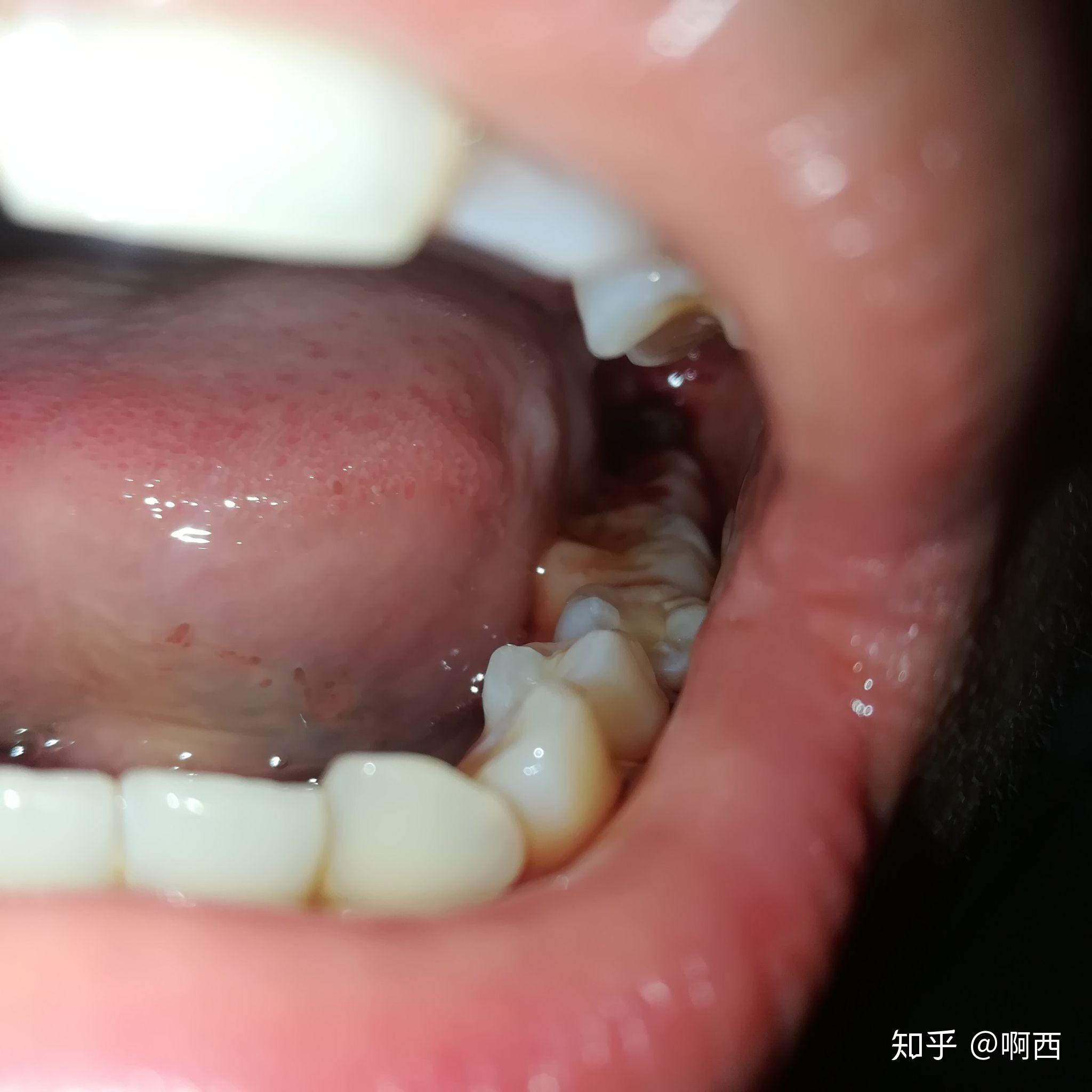 长了四颗阻生智齿是什么样的体验? - 知乎