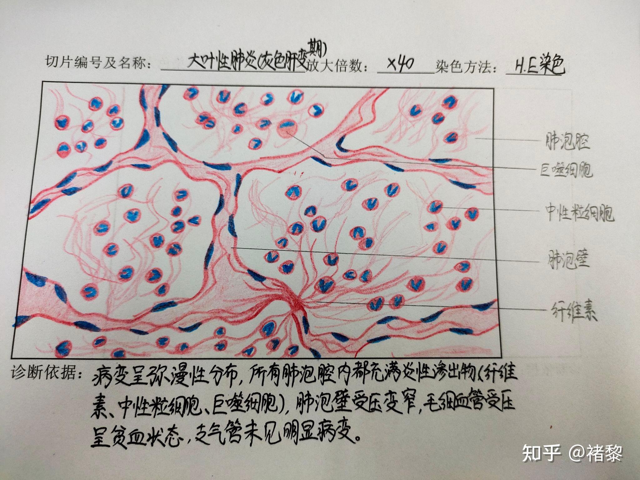有没有人有病理的结肠腺癌红蓝铅笔手绘图啊?